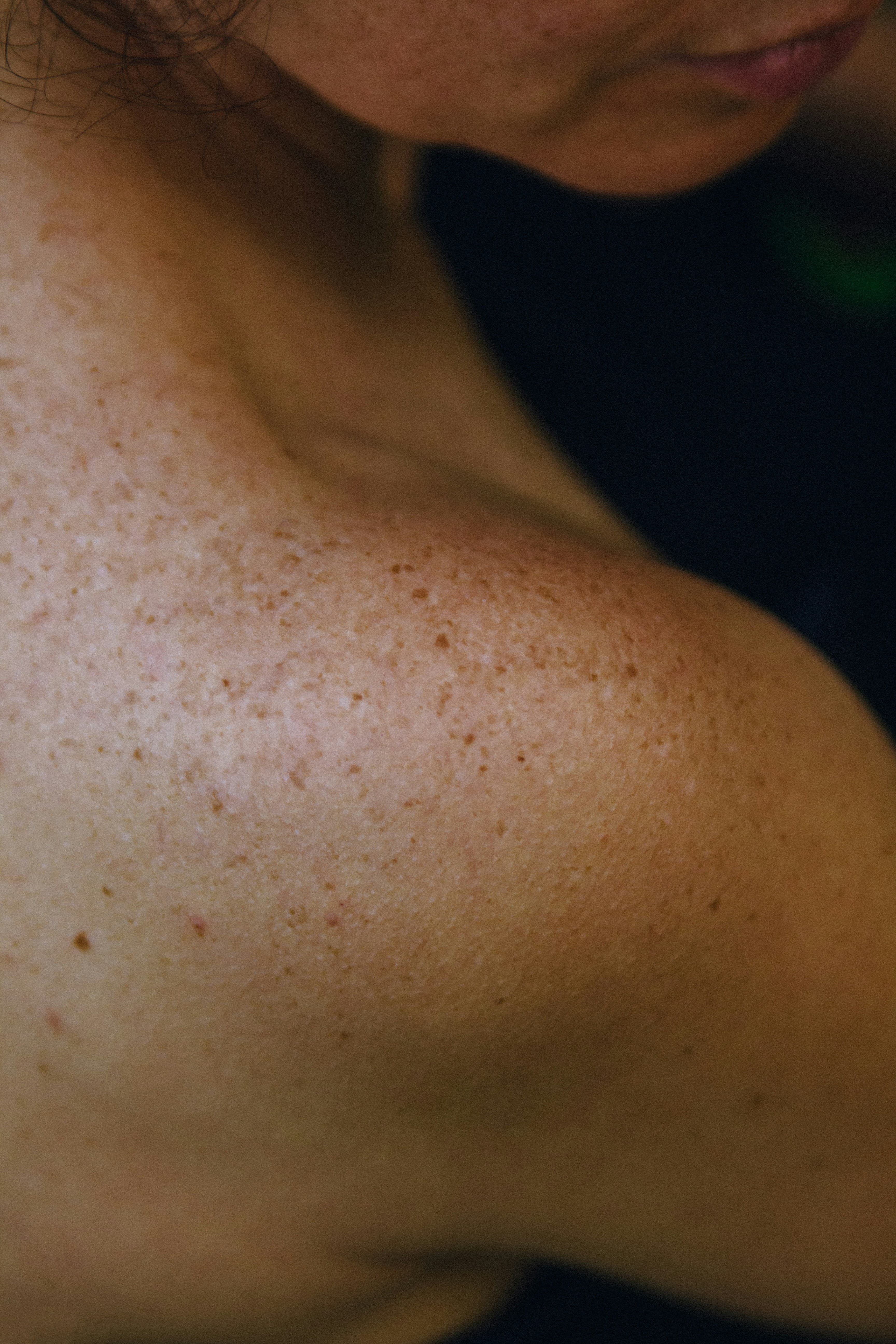 Womens shoulder with freckles on it